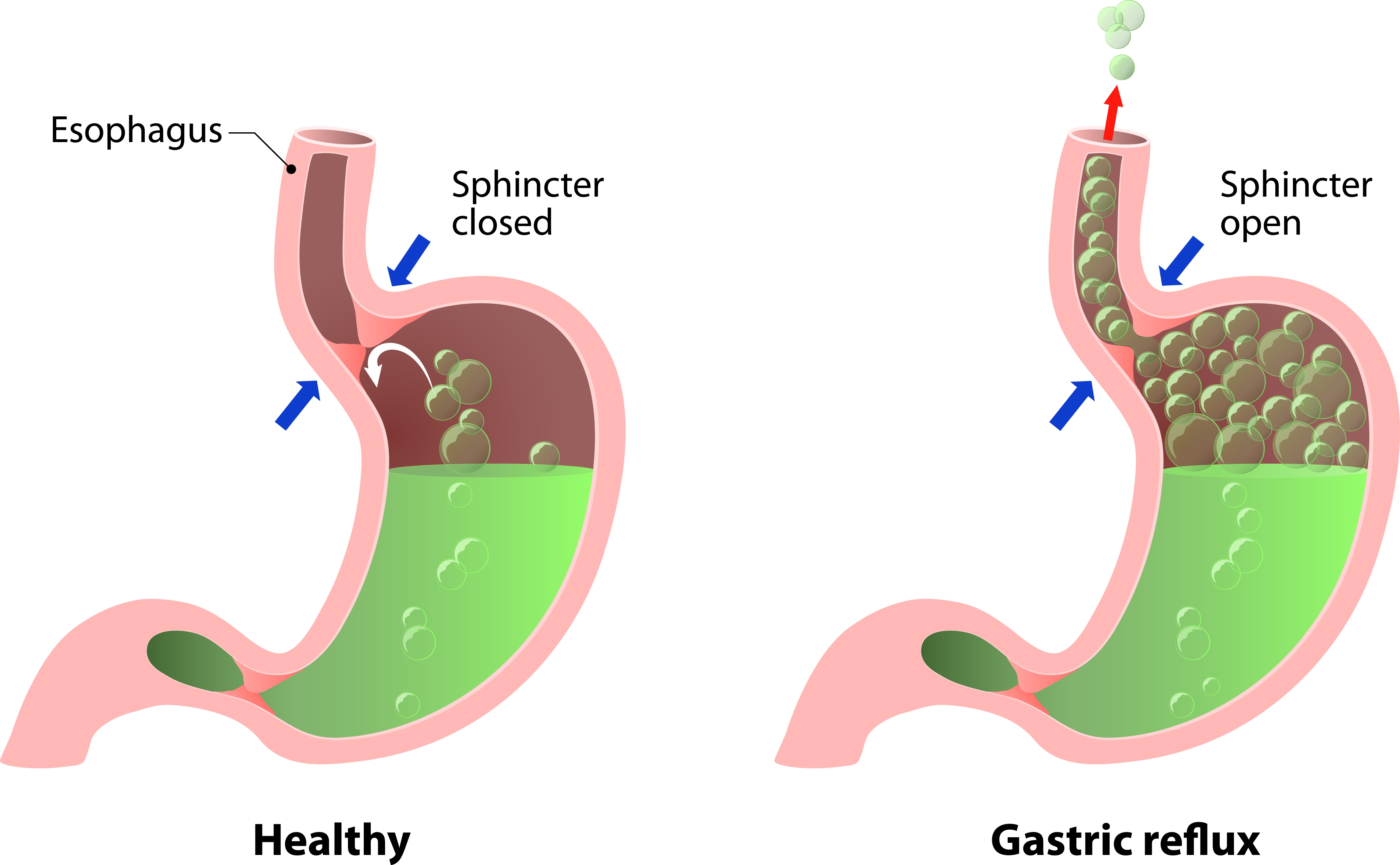 胃食管反流图解图片