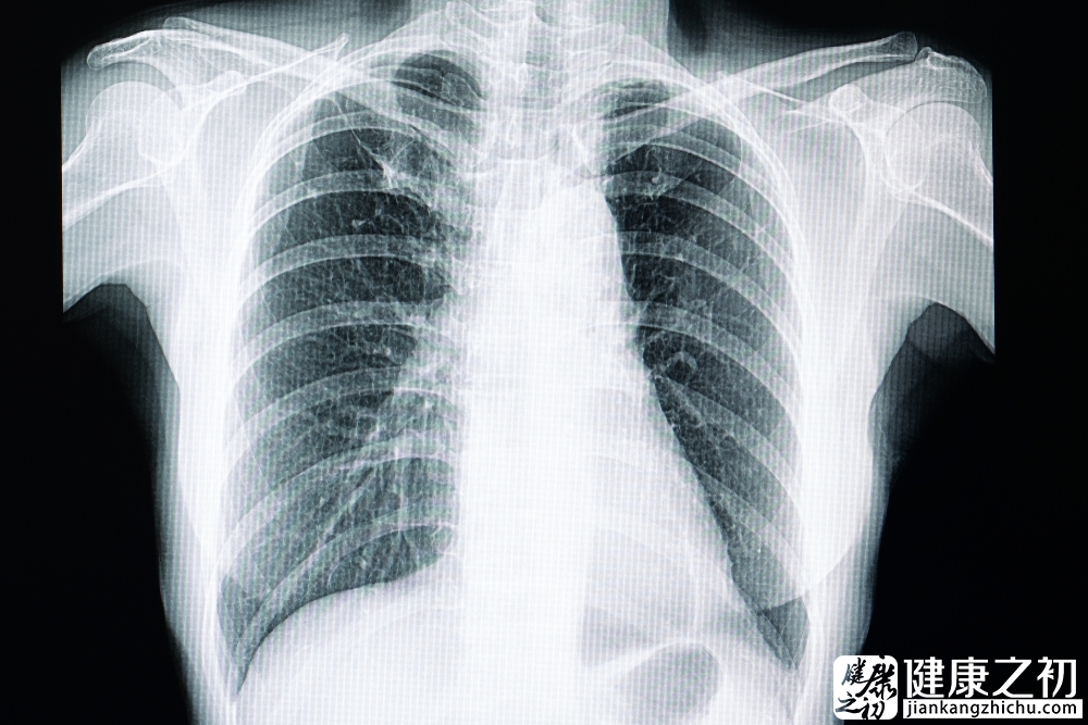 肺纤维化.jpg